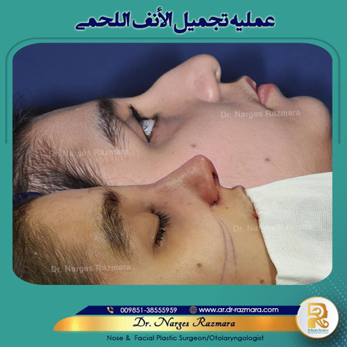 جراحه الانف اللحمی